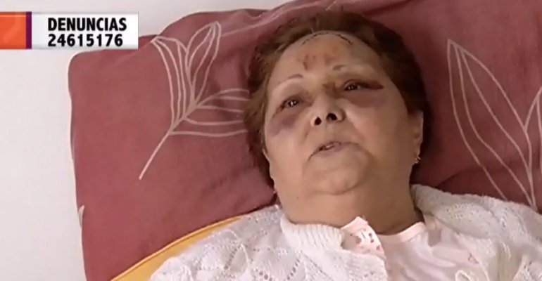 Mujer pide justicia tras caer en bus Transantiago y quedar con lesiones graves