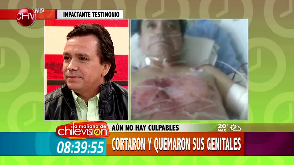 Quemado con soda cáustica: 