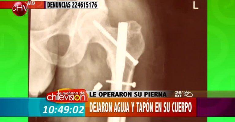 Insólito: Operan a hombre de su pierna y dejan en su interior tapón y aguja