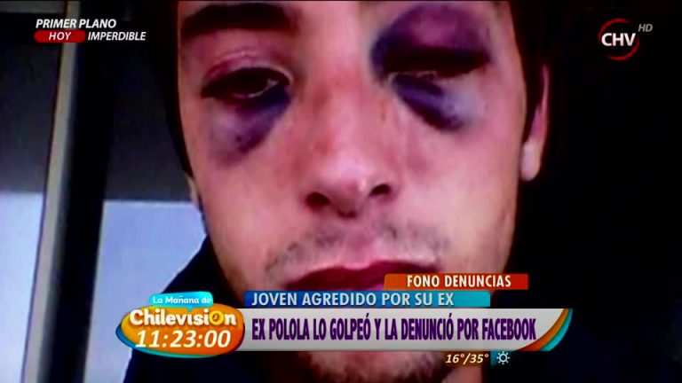 Joven denunció brutal agresión por parte de su polola por Facebook (2/2)