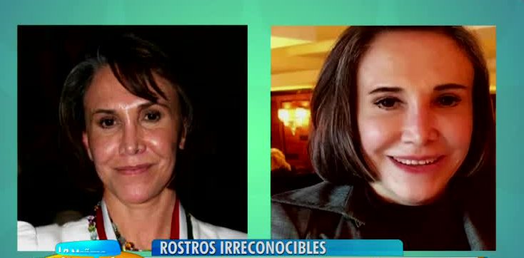 Conoce a los famosos que han deformado sus rostros con exceso de cirugías
