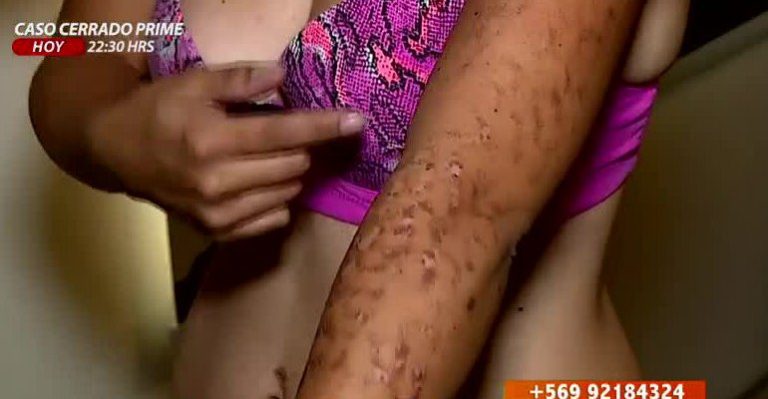 Mujer denuncia haber sido quemada tras someterse a depilación láser