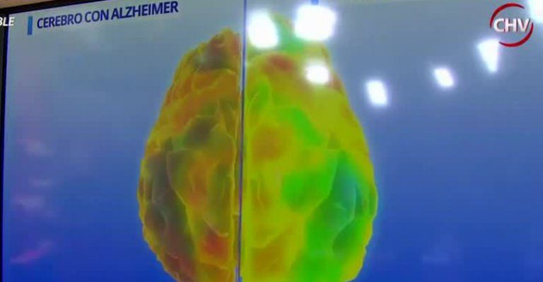 Conozca en detalles todo lo que debe saber sobre el Alzheimer - Parte 2