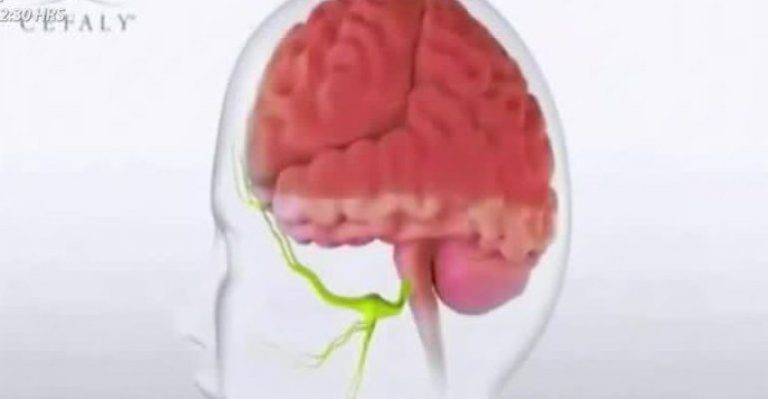 Todo lo que necesitas saber sobre los dolores de cabeza