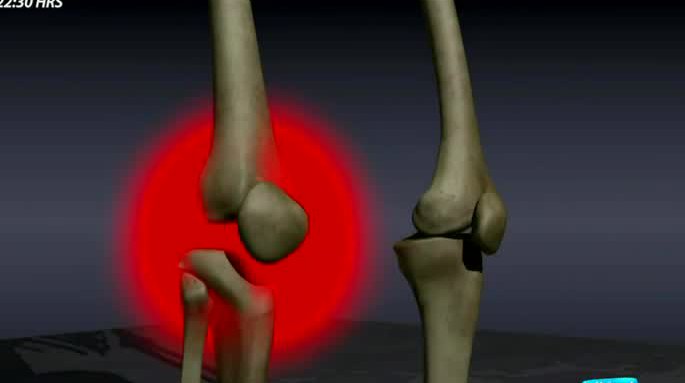 Entérese cuáles son las diferencias entre la Artrosis y la Artritis - Parte 1