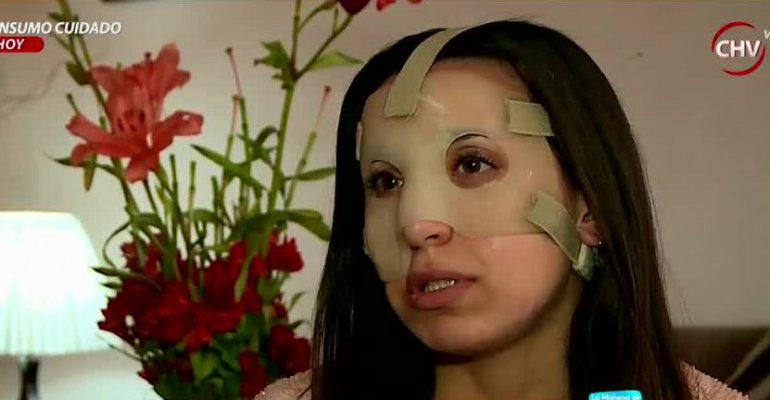 Peluquera atacada por colega debe usar máscara para esconder cicatriz - Parte 2