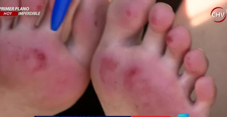 Niños entraron a piscina en Club Lonquén y salieron con quemaduras