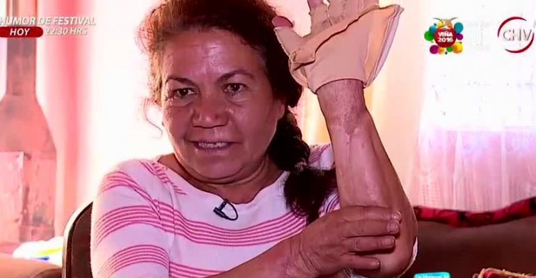 Guardia quemada hace tres años en Maipú relata su historia de superación