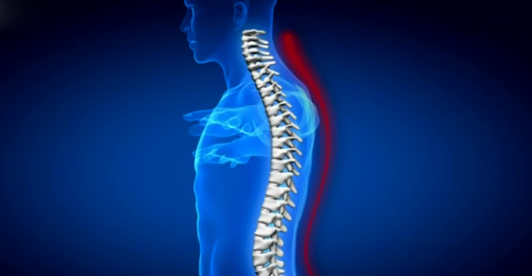 Entérese por qué se produce el dolor de espalda y lumbago