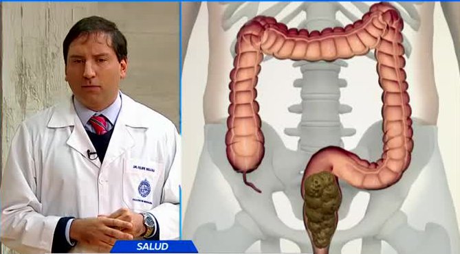 Aprende a detectar y prevenir el cáncer de colon