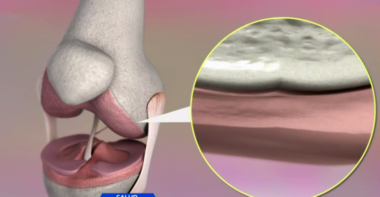 Conozca las diferencias entre la artrosis y la artritis