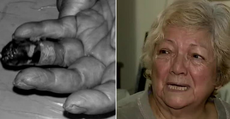 Mujer terminó con fractura en dedo tras examen de rutina