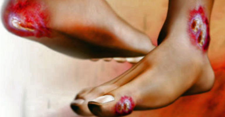 Pie diabético - Vidas en Riesgo