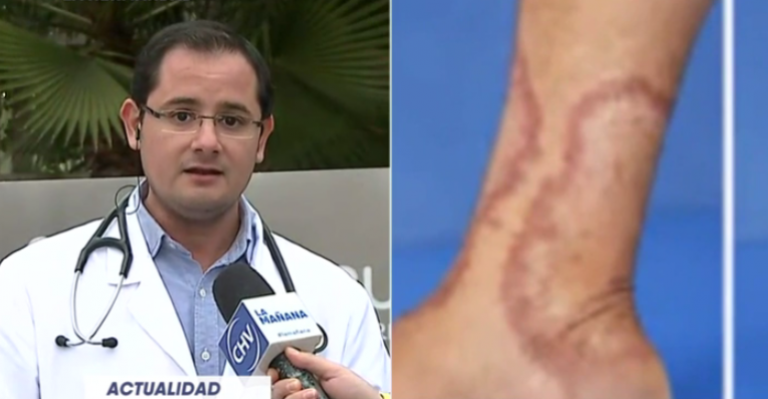 Médico aclaró las dudas sobre los casos de Lepra en Chile