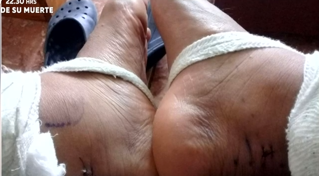 Joven denuncia que le operaron pie equivocado