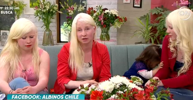 Conversamos ¿Cómo es ser albino en nuestro país?