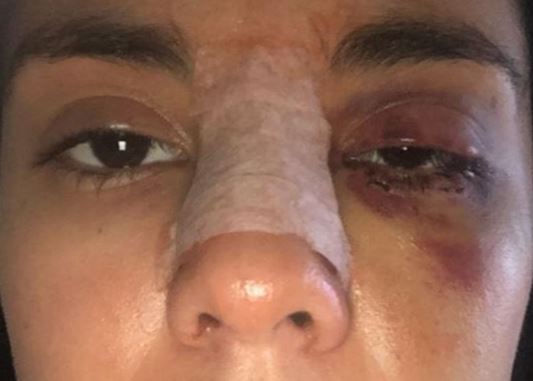 Su novio la golpeó tan fuerte que necesitó varias cirugías para poder curar las fracturas en su nariz