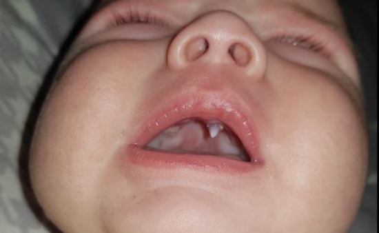 Madre mostró en redes sociales el extraño colmillo que le creció a su hijo en solo una noche