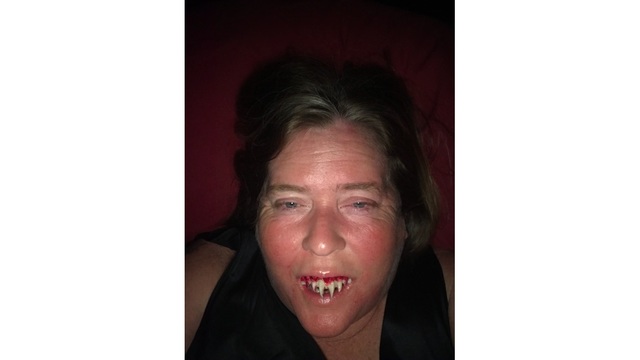 Mujer vivió horas de angustia tras no poder quitarse sus dientes postizos de Halloween