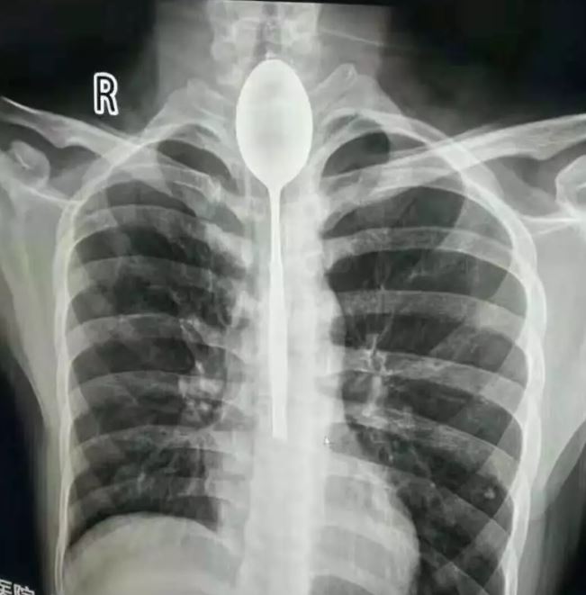 Extraen cuchara de 20 centímetros del esófago de un joven: se la tragó cuando estaba borracho