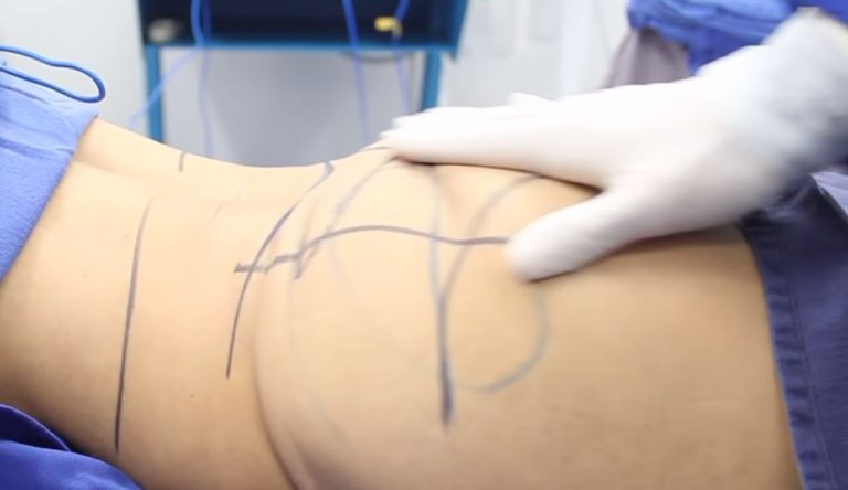 El alto costo de la belleza: Pacientes denuncian a médicos por sus fallidas cirugías plásticas