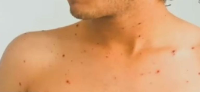 Autoridad sanitaria metropolitana confirmó segundo caso de sarampión en el país