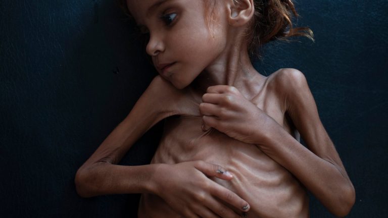 Falleció Amal Hussain, la niña que retrató la desnutrición infantil en Yemen