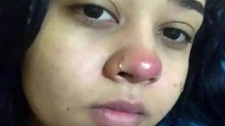 Joven de 20 años quedó parapléjica tras hacerse piercing en la nariz
