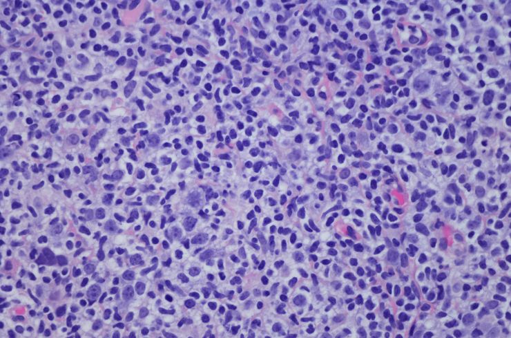Prometedora vacuna contra el cáncer logra curar el linfoma de 3 pacientes