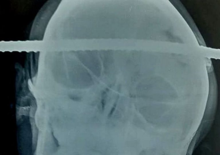 Joven obrero cayó a un pozo y un fierro le perforó la cabeza: Por milímetros se salvó de la muerte