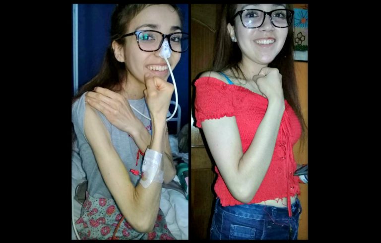 “Pesaba 27 kilos y me desmayaba en clases”: Relato de una joven anoréxica que exige que la enfermedad esté en el Auge