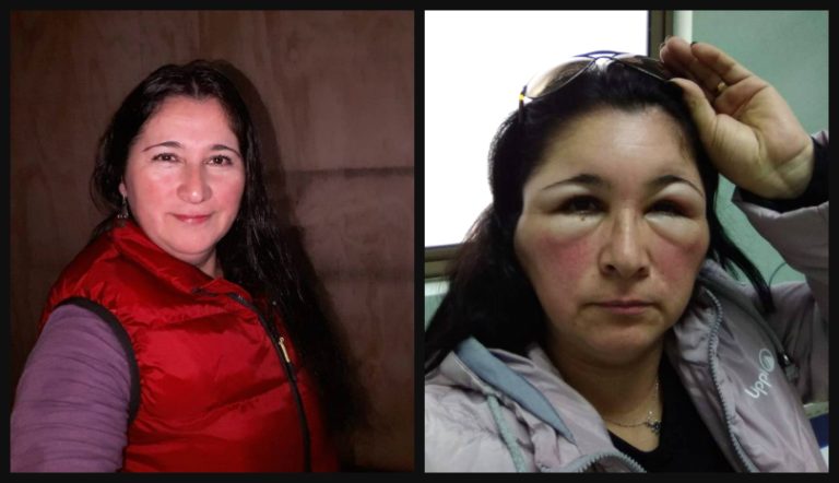 Quedó desfigurada y hospitalizada: Mujer se tiñó el pelo, pero no sabía que era alérgica al amoniaco