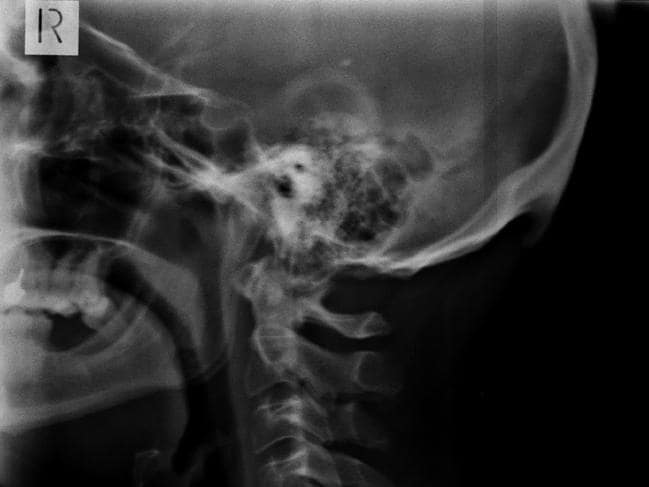 Científicos australianos analizaron radiografías y descubrieron un inédito desarrollo de cuernos en personas de 18 a 30 años