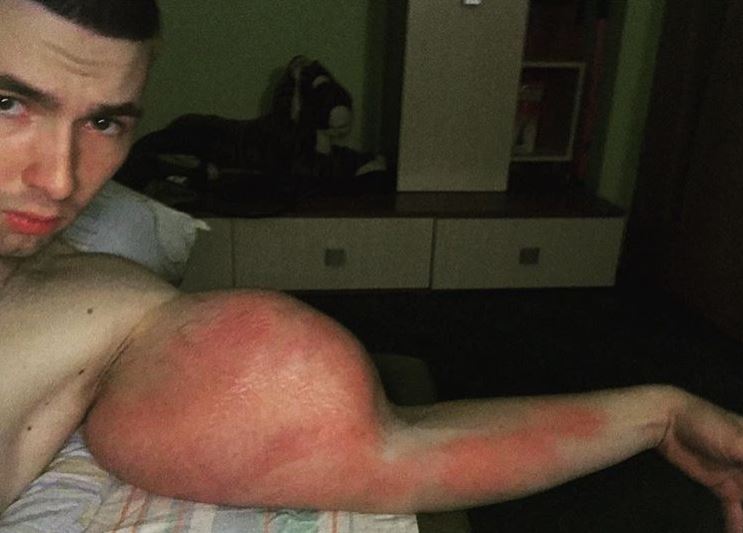 Se inyectó aceite en sus brazos para aumentar su tamaño y ahora está desesperado: Necesita una operación