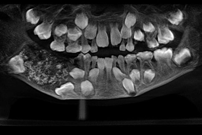 ¿Dolor de muelas?: A niño le encontraron 526 dientes alojados en su mandíbula tras visistar al dentista