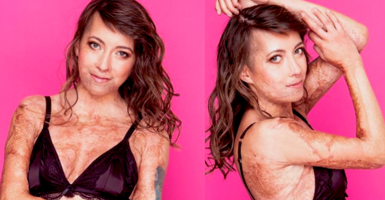 Joven que sufrió quemaduras en su cuerpo entregó potente mensaje de aceptación