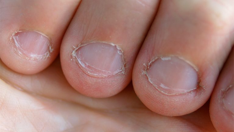 Hombre estuvo al borde de la muerte tras contraer infección por comerse reiteradamente las uñas