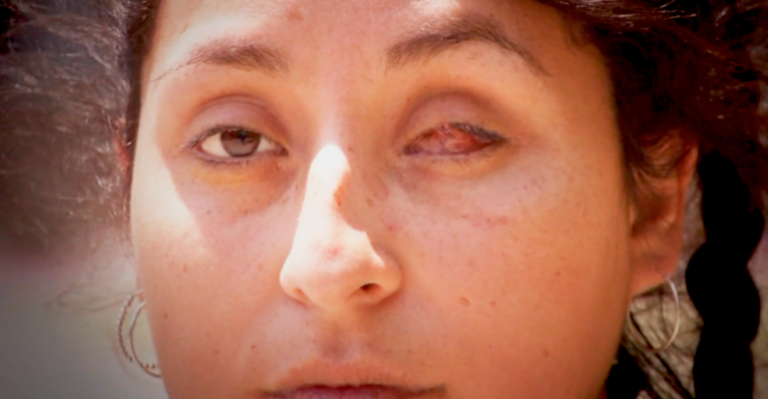 Mujer perdió visión de ojo izquierdo tras ser atacada por vecino con una honda