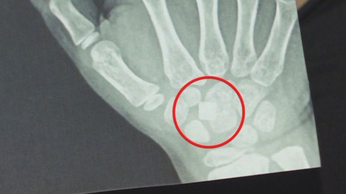 Denuncian negligencia médica: Niña vive hace tres meses con vidrio enterrado en su mano