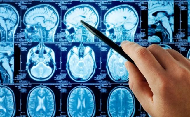 EE.UU: Confirman caso de rara ameba que infecta y destruye el cerebro