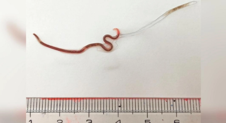 Sushi del terror: Encuentran un gusano vivo en garganta de una mujer