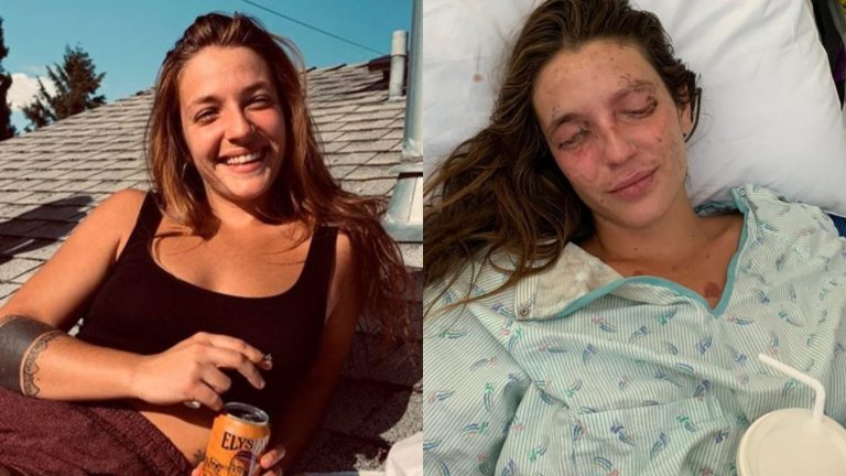 Joven que se quemó la cara y los ojos con soda cáustica creó campaña para poder operarse