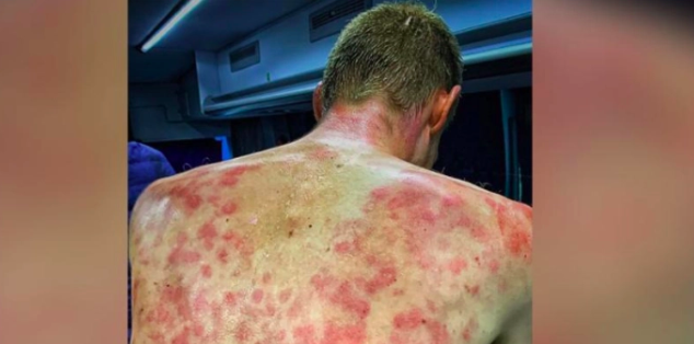 Así quedó la espalda de un ciclista tras tormenta de granizos del porte de una pelota de ping pong