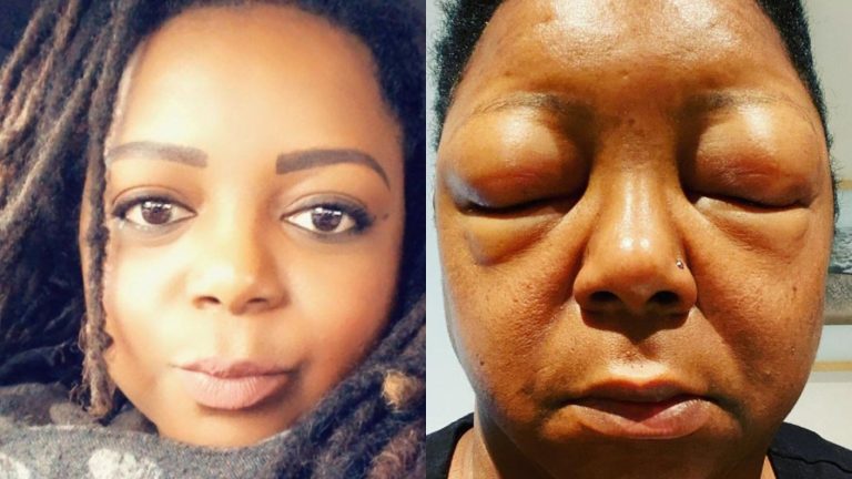 Sufrió grave reacción alérgica tras teñirse el pelo: Hinchazón de su rostro no le permitía ver