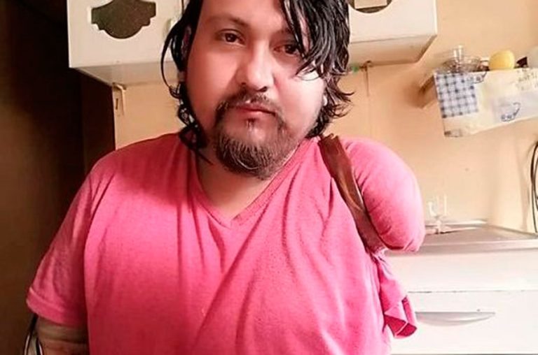 Perdió sus brazos y piernas, vive con abuelos discapacitados y pide ayuda para mantenerlos