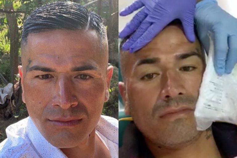 Kike Acuña se puso botox: 