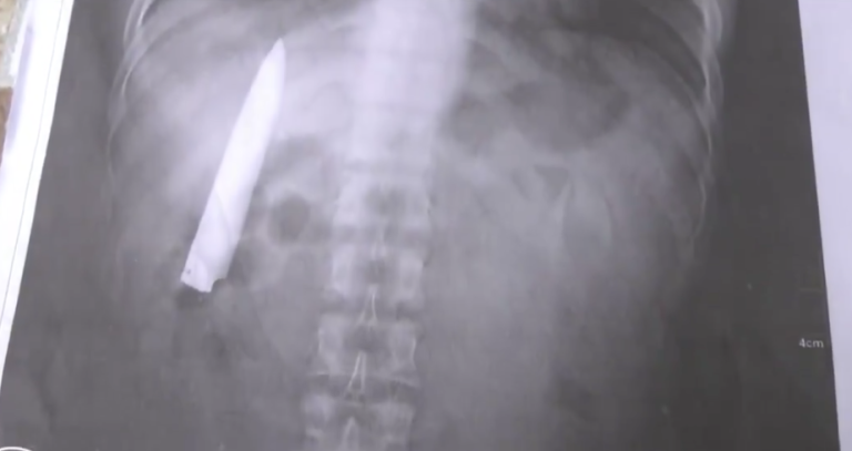 Fue apuñalado por delincuentes y 14 meses después supo que el cuchillo continuaba dentro de su cuerpo