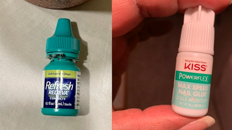 Confundió las gotas para ojos con un pegamento de uñas y estuvo a punto de perder su visión