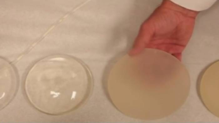 Mujer trans murió tras recibir inyección de silicona líquida en Concepción