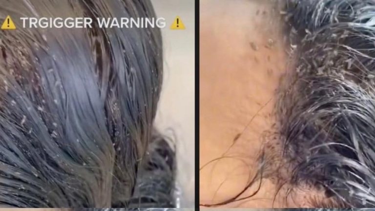 ¡Impactante video! Viralizan registro de niña con más de 15 mil piojos en su cabeza